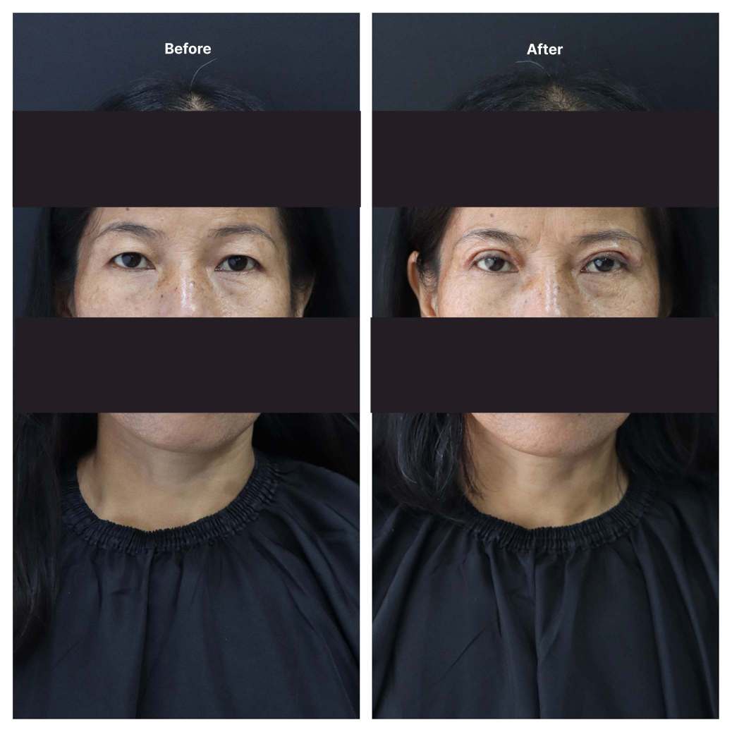 Eyelid Surgery KOQ10